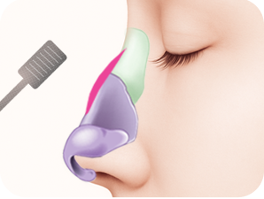 Rhinoplasty in Korea at LABOM Plastic Surgery in Seoul