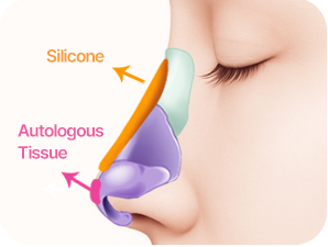 Rhinoplasty in Korea at LABOM Plastic Surgery in Seoul