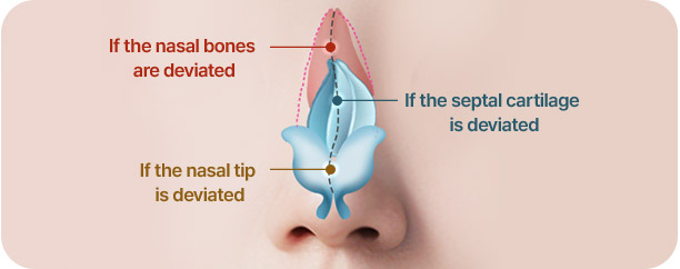 Rhinoplasty in Korea at LABOM Plastic Surgery in Seoul