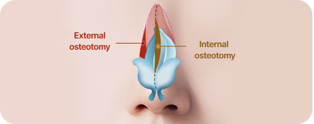 Rhinoplasty in Korea at LABOM Plastic Surgery in Seoul