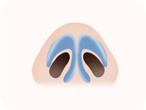 Rhinoplasty in Korea at LABOM Plastic Surgery in Seoul