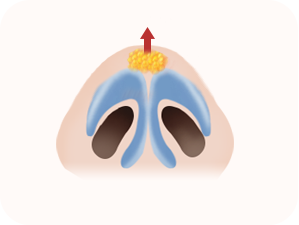 Rhinoplasty in Korea at LABOM Plastic Surgery in Seoul