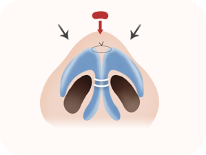 Rhinoplasty in Korea at LABOM Plastic Surgery in Seoul