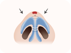 Rhinoplasty in Korea at LABOM Plastic Surgery in Seoul