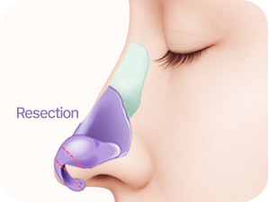 Rhinoplasty in Korea at LABOM Plastic Surgery in Seoul