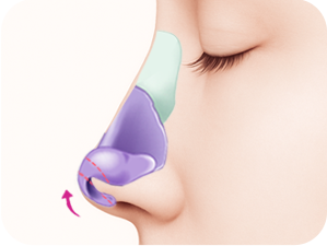 Rhinoplasty in Korea at LABOM Plastic Surgery in Seoul