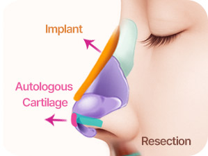 Rhinoplasty in Korea at LABOM Plastic Surgery in Seoul