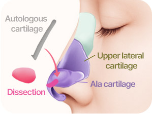 Rhinoplasty in Korea at LABOM Plastic Surgery in Seoul