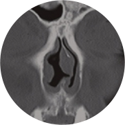 Rhinoplasty in Korea at LABOM Plastic Surgery in Seoul