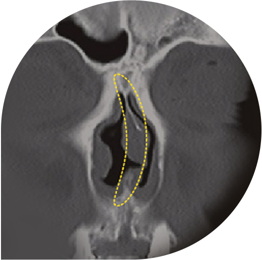 Rhinoplasty in Korea at LABOM Plastic Surgery in Seoul