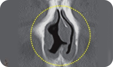 Rhinoplasty in Korea at LABOM Plastic Surgery in Seoul