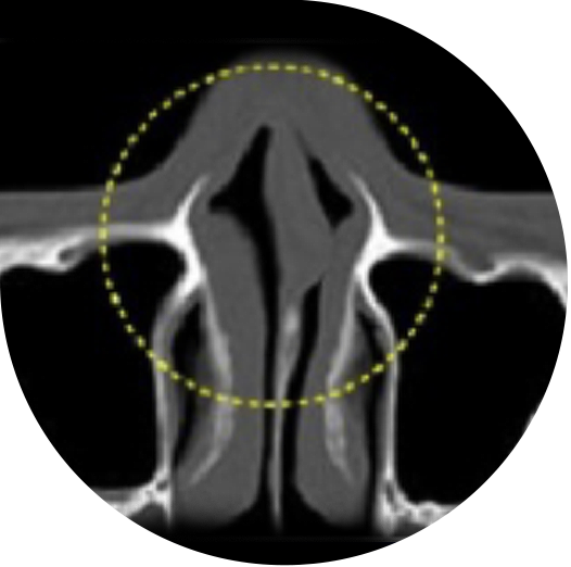 Rhinoplasty in Korea at LABOM Plastic Surgery in Seoul