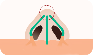 Rhinoplasty in Korea at LABOM Plastic Surgery in Seoul