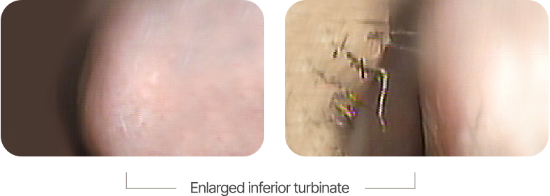Rhinoplasty in Korea at LABOM Plastic Surgery in Seoul