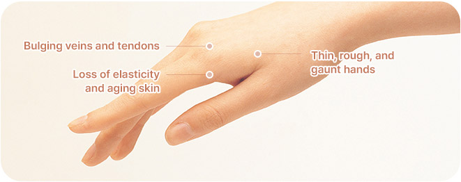 Hand Fat Grafting in Korea at LABOM Plastic Surgery in Seoul
