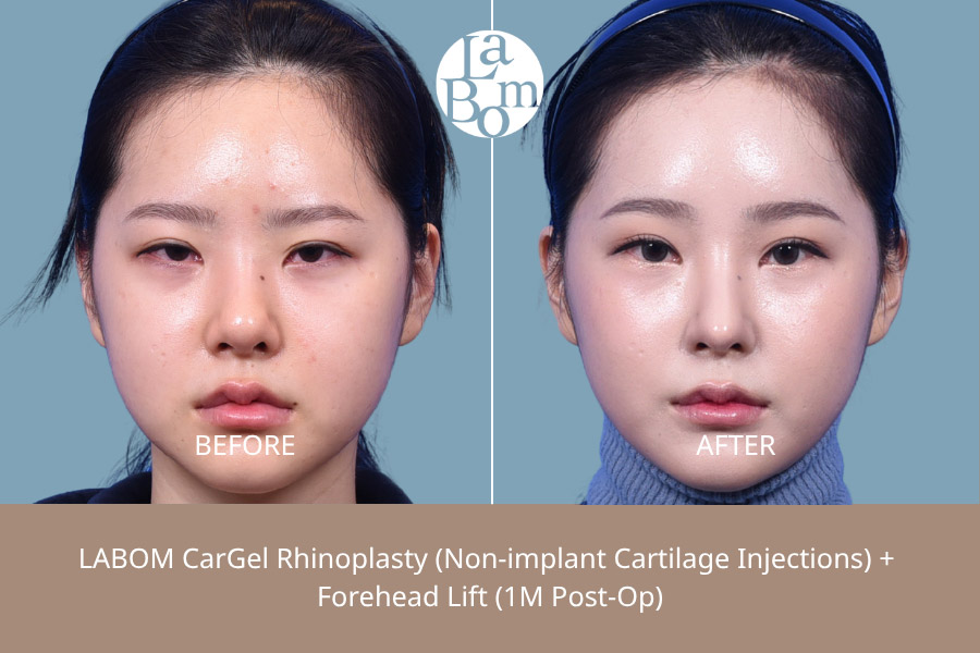 Non-Surgical Rhinoplasty In Korea