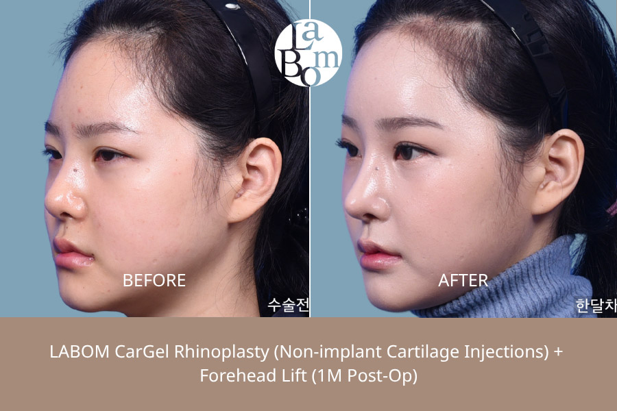 Non-Surgical Rhinoplasty In Korea