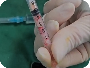 Non-surgical CarGel Rhinoplasty in Korea at LABOM Plastic Surgery in Seoul