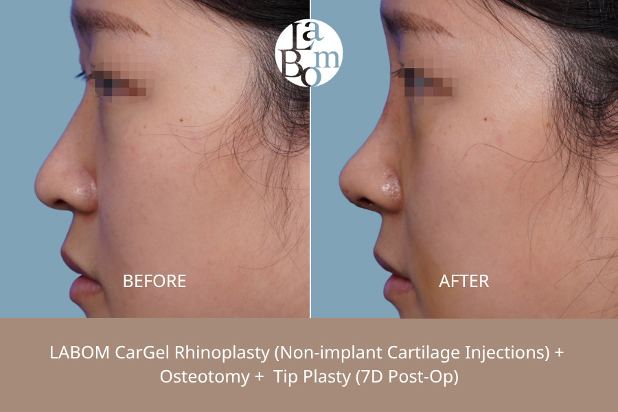 Non-Surgical Rhinoplasty In Korea