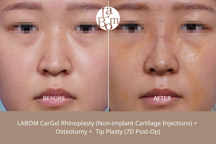 Non-Surgical Rhinoplasty In Korea