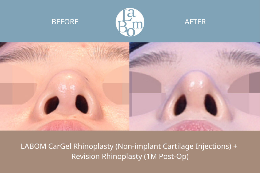 Non-Surgical Rhinoplasty In Korea