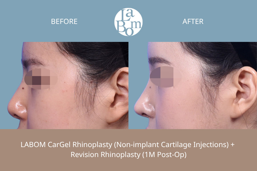 Non-Surgical Rhinoplasty In Korea