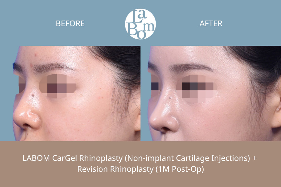 Non-Surgical Rhinoplasty In Korea