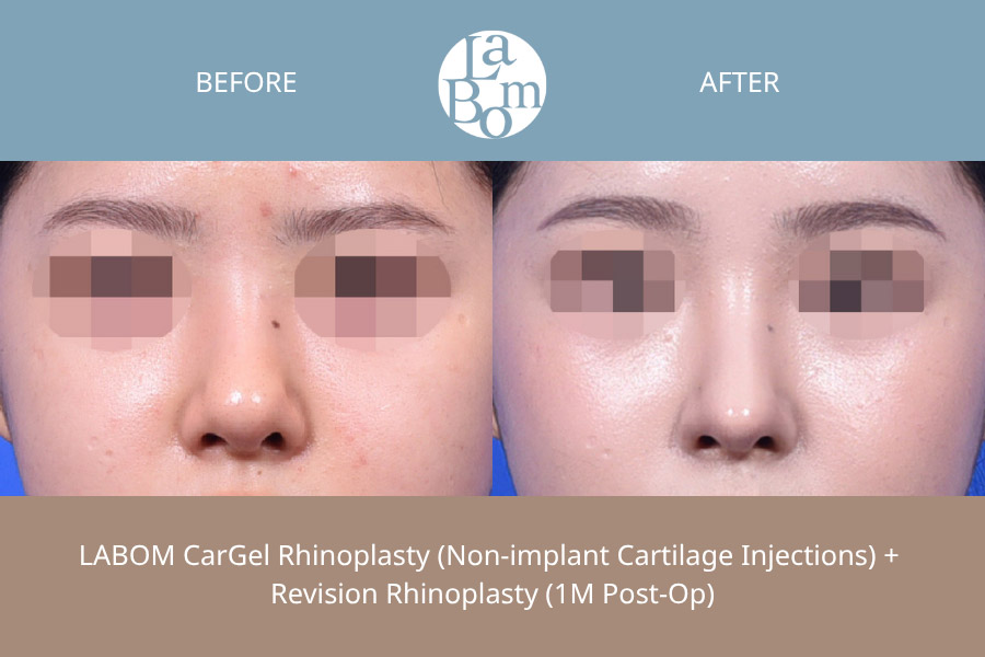 Non-Surgical Rhinoplasty In Korea