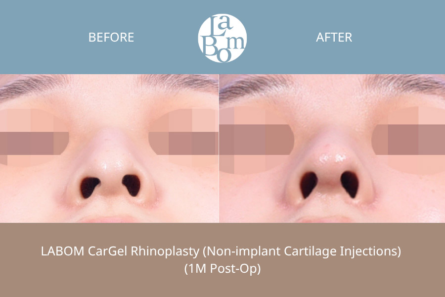Non-Surgical Rhinoplasty In Korea