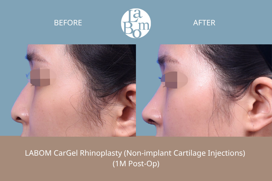 Non-Surgical Rhinoplasty In Korea