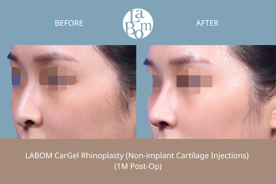 Non-Surgical Rhinoplasty In Korea