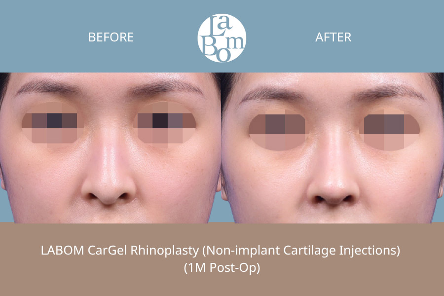 Non-Surgical Rhinoplasty In Korea
