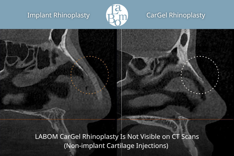 Non-Surgical Rhinoplasty In Korea