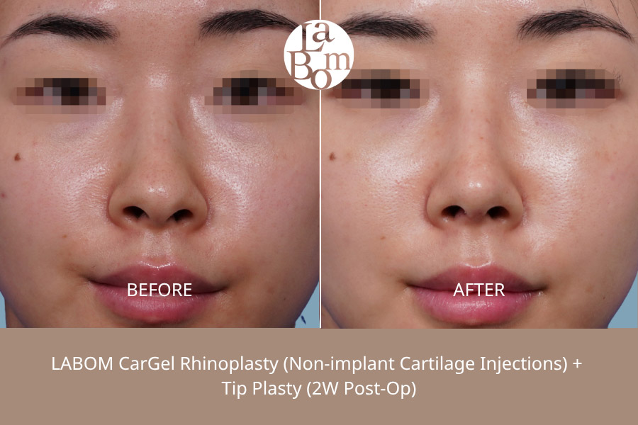 Non-Surgical Rhinoplasty In Korea