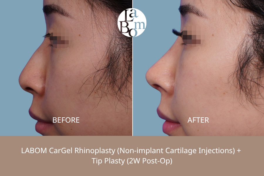 Non-Surgical Rhinoplasty In Korea